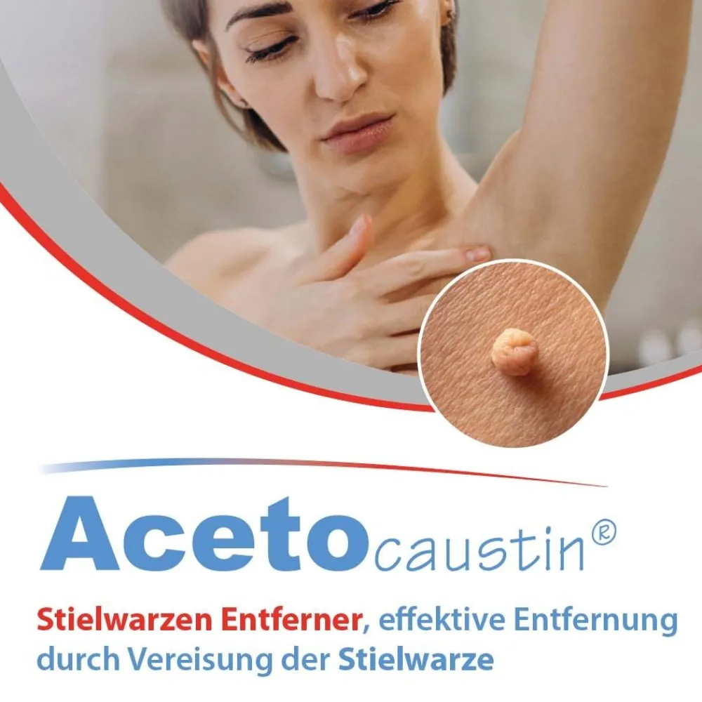 Acetocaustin Stielwarzen Entferner Stift> Clearance