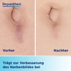 BepanCare Narben-Gel mit Massage-Roller – macht Narben glatter, flacher und weicher><noscript><img width=