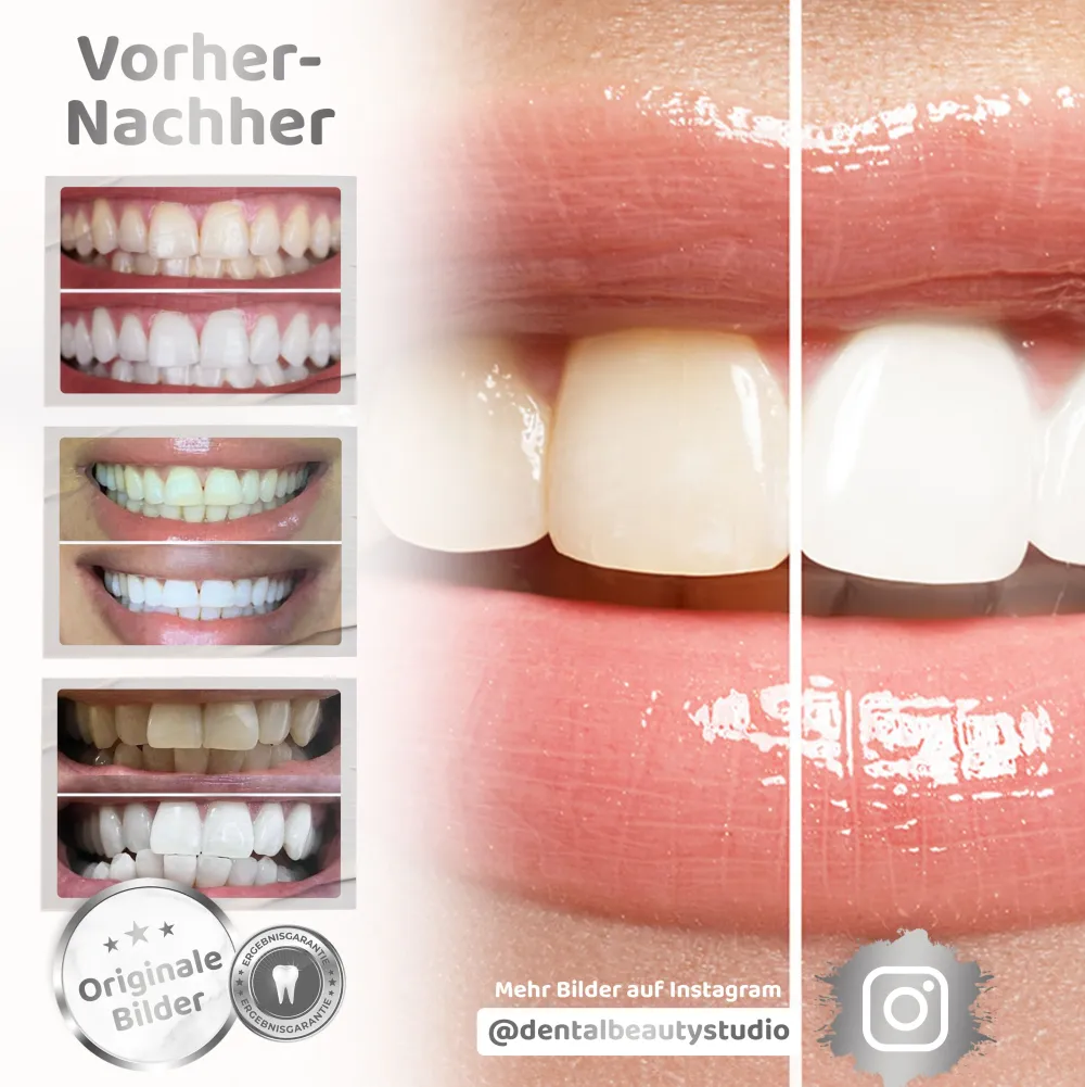 Dental Beauty Zahnbleaching-Set US-Whitening Technologie Rapid+> Outlet
