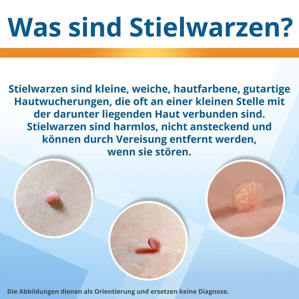 EXTRA: Stielwarzen entfernen, Vereisungsmittel zur Entfernung von Stielwarzen an Hals, Brust & Achseln>EndWarts Best