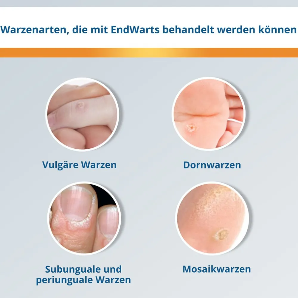 FREEZE: Vereisungsmittel zur Entfernung von Warzen an Händen, Armen & Füßen|EndWarts Best