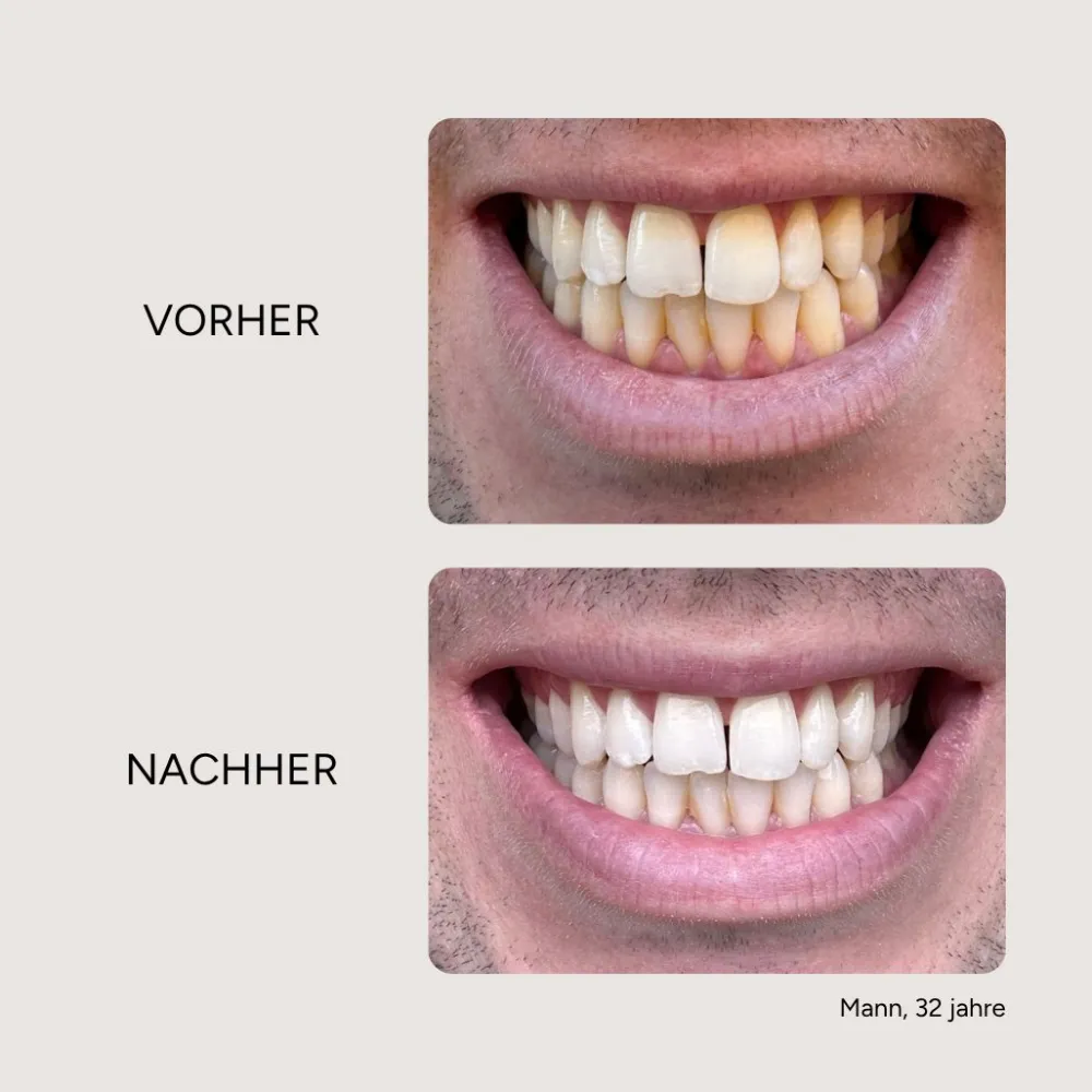 Etinour Essential Whitening & Remineralisierungskit> Sale