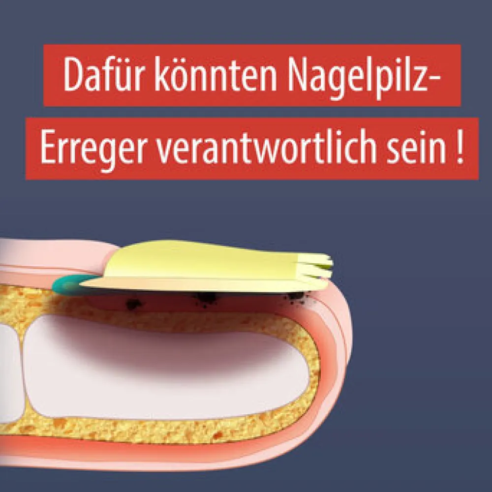 ® Anti-Nagelpilz Liquid - Nagelpilz Nagellack für Füsse und Hände - Wissenschaftlich bestätigte Wirkweise>Evolsin Online