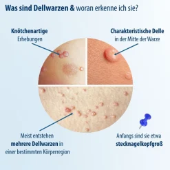 Evolsin® Dellwarzen Mittel I Für Erwachsene & Kinder ab 2 Jahren I Dellwarzen Behandlung mit Ätzkali> Discount