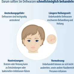 Evolsin® Dellwarzen Mittel I Für Erwachsene & Kinder ab 2 Jahren I Dellwarzen Behandlung mit Ätzkali><noscript><img width=