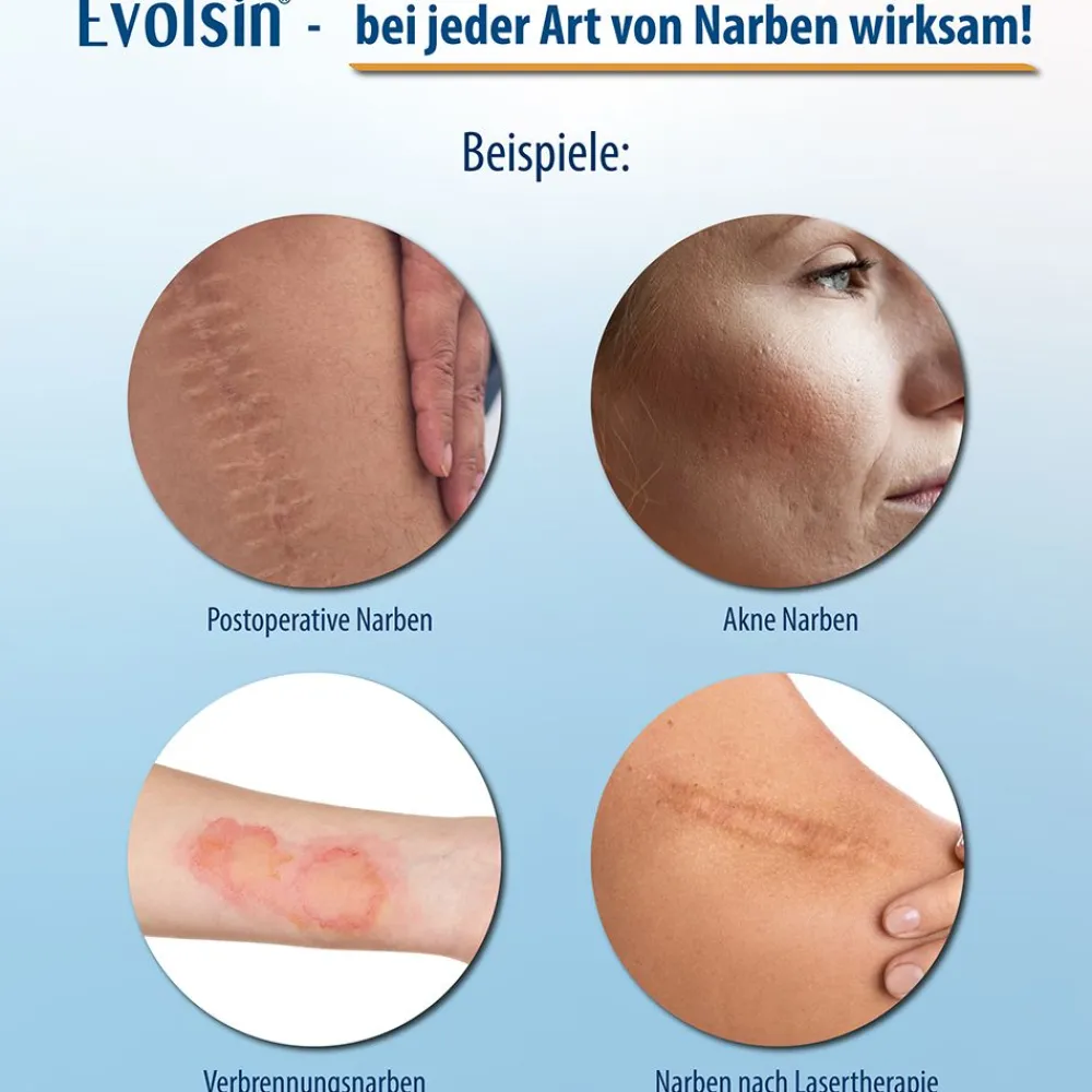 Evolsin® Transparentes Narbenpflaster – für Narben aller Art – Narbenpflaster aus Silikon reduziert sichtbar Narben - für eine einfache Behandlung (200 cm)| Outlet