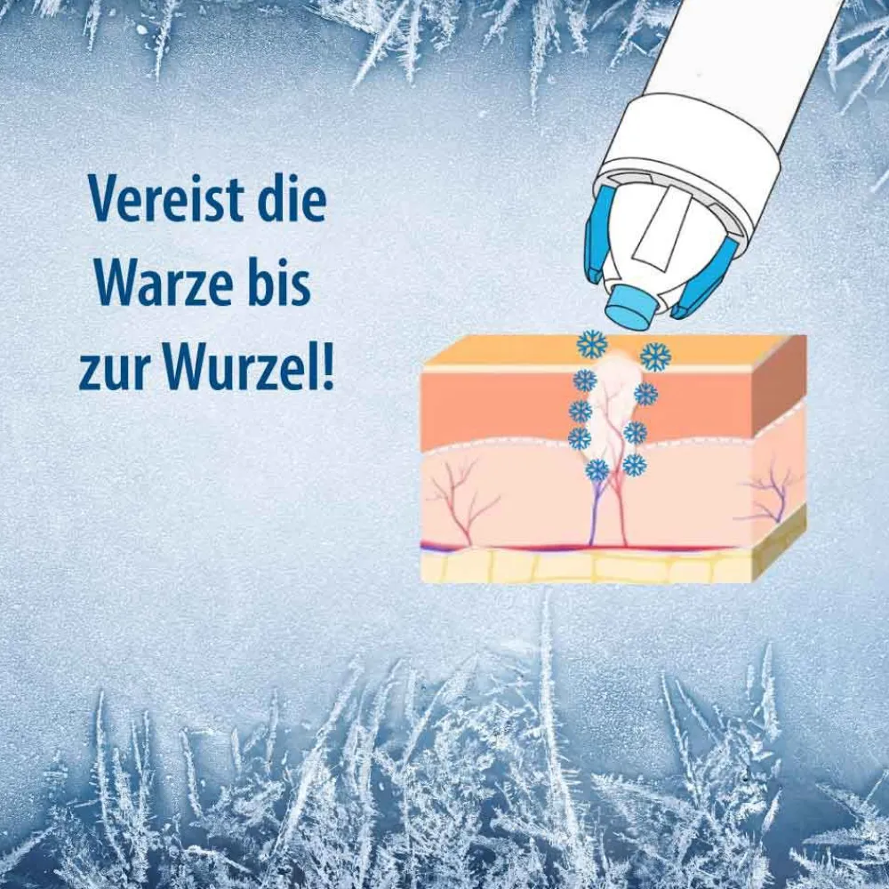 ® Warzenvereiser – Entfernung von Warzen und Dornwarzen sicher & effektiv|Evolsin Online