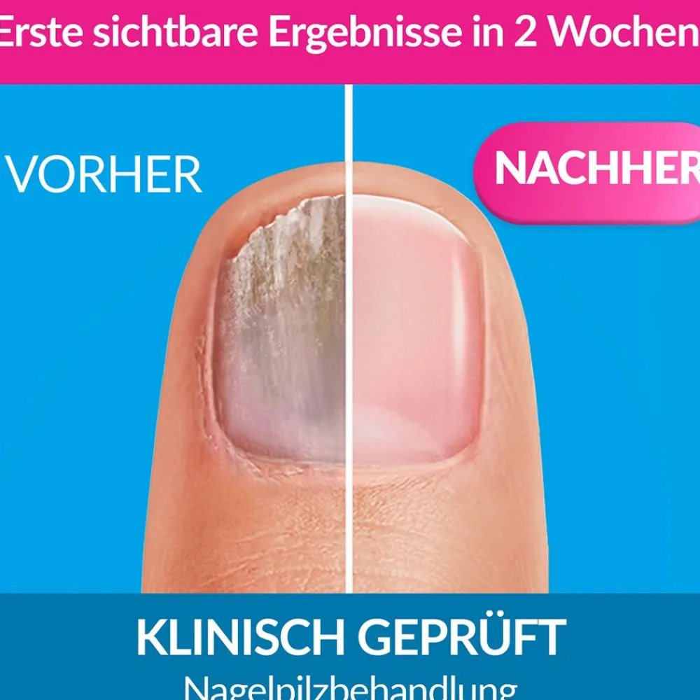 excilor® Lösung gegen Nagelpilz| Hot
