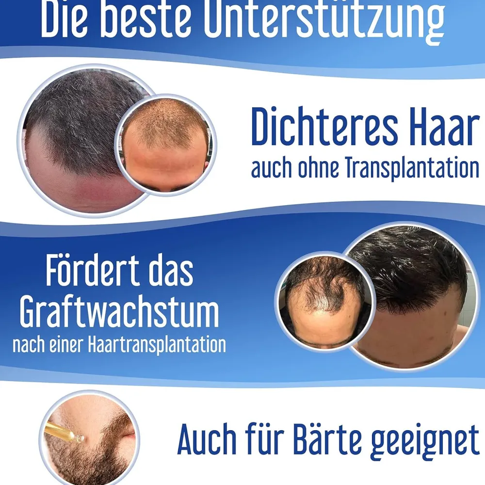 Hairforte Spray 3% Procapil gegen Haarverlust DHT Blocker| Discount
