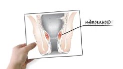 ® Feuchtpflegetücher + ® Hämorrhoidensalbe mit Applikator><noscript><img width=