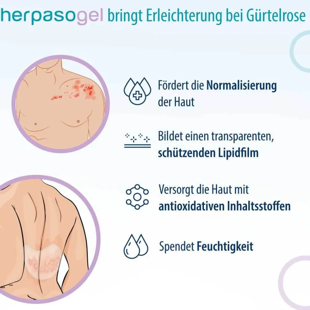 Herpasogel bei Gürtelrose | Fördert die Normalisierung der Haut bei Herpes zoster> Hot