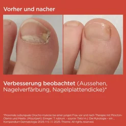 SI-NAILS® MicoXpert gegen Nagelpilz><noscript><img width=