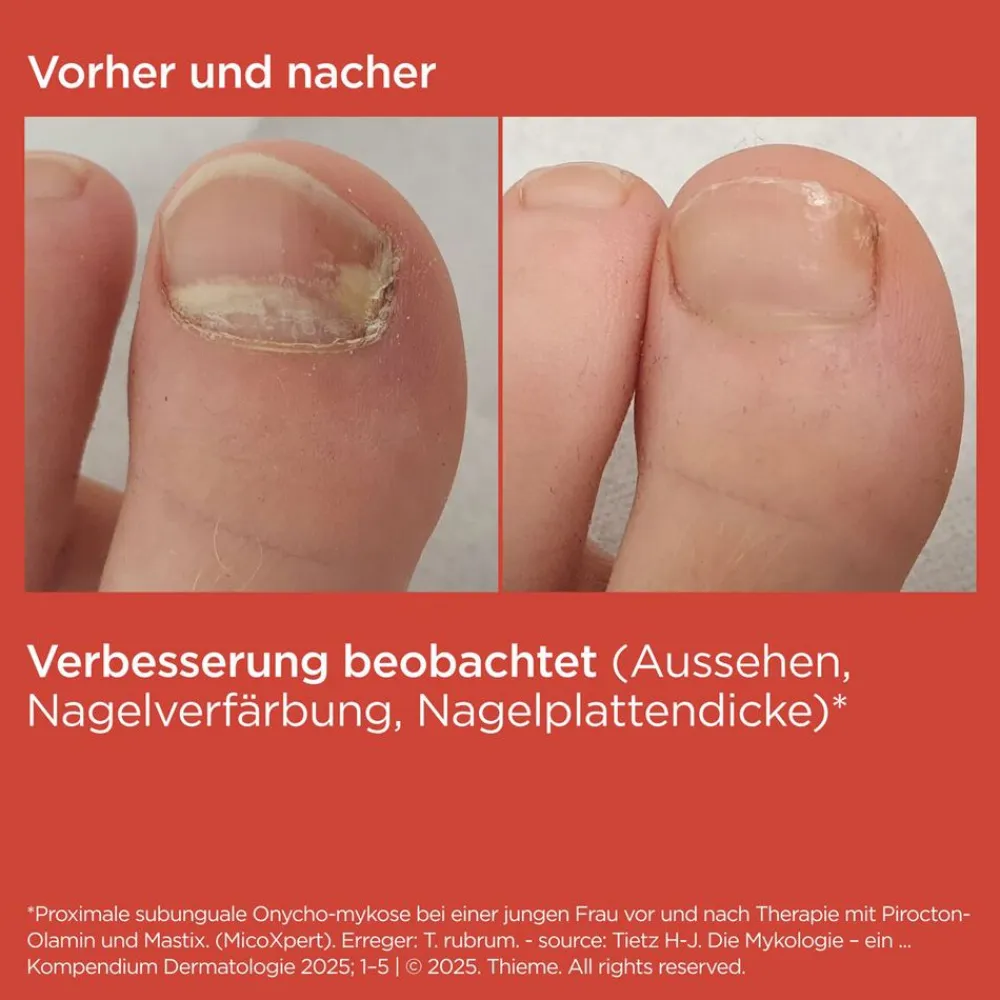 SI-NAILS® MicoXpert gegen Nagelpilz>ISDIN