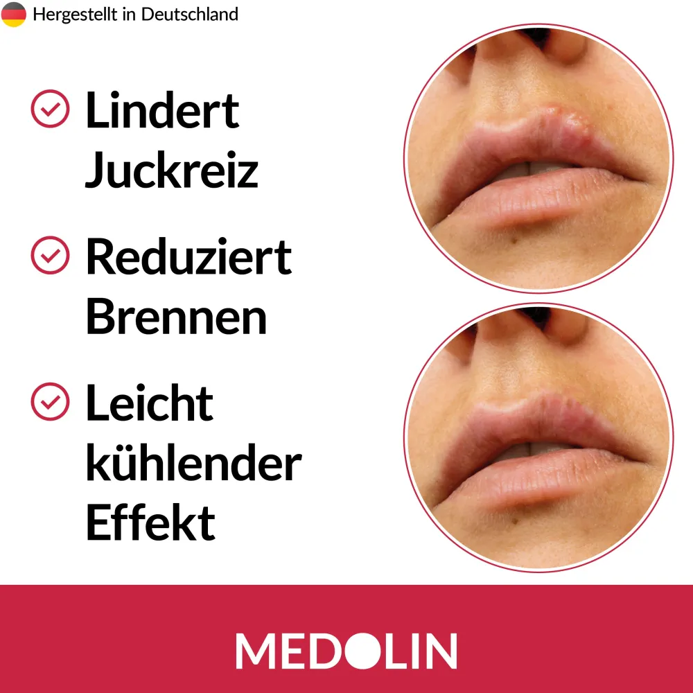 Medolin® Herpesgel - Herpescreme gegen Lippenherpes - Herpes Creme für gesunde Lippen| New