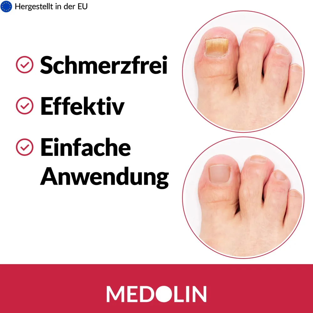Medolin® Nagelpilz Lösung - Nagelpilz Lack - Effektive Nagelpilzkur - Nagelpilz Nagellack> Best