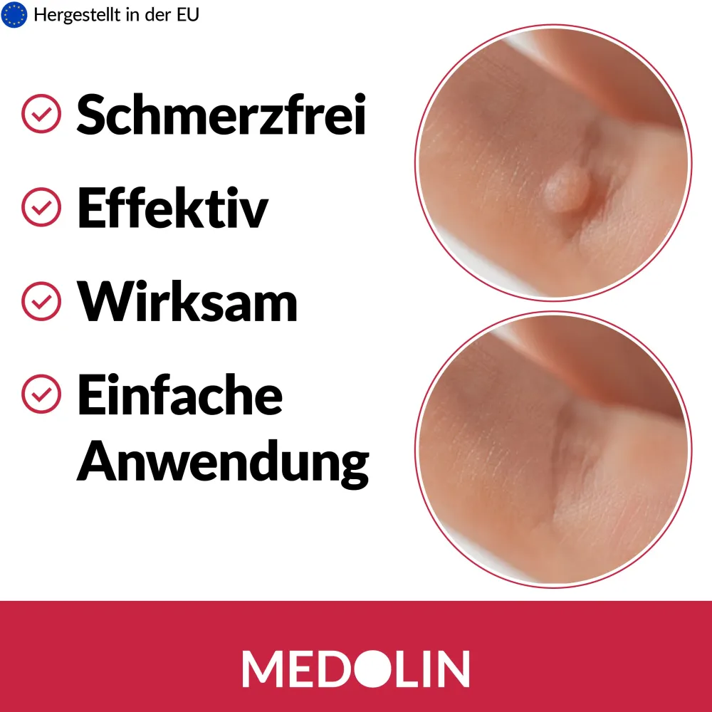 Medolin® Warzen Tinktur 2er Set| Best