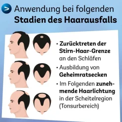 Minoxidil Dexcel® 50 mg/ml Spray, bei erblich bedingtem Haarausfall bei Männern| Online