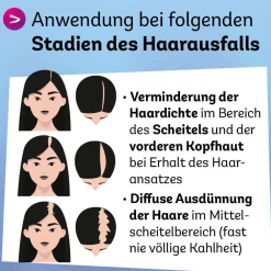 Minoxidil Dexcel® 20 mg/ml Spray, bei erblich bedingtem Haarausfall bei Frauen| Clearance