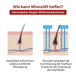 MINOXIDIL Pharma 50 mg/ml|Doppelherz Sale