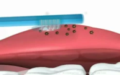 Tong-Clin Gel|Miradent Clearance