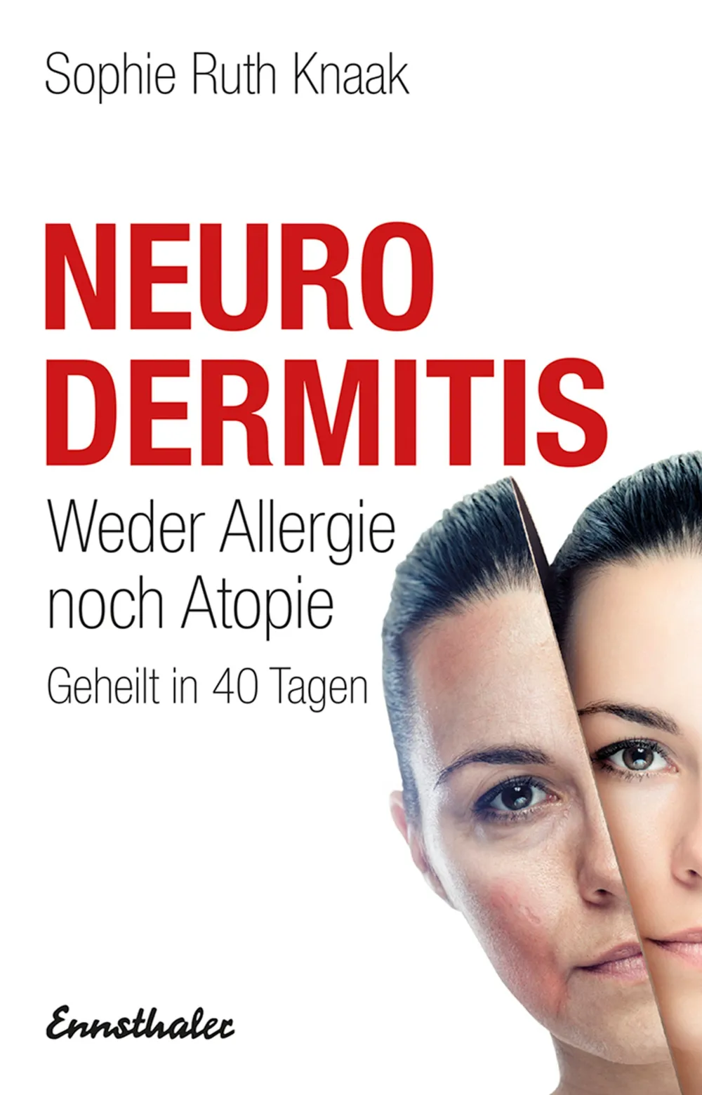 Neurodermitis| Hot