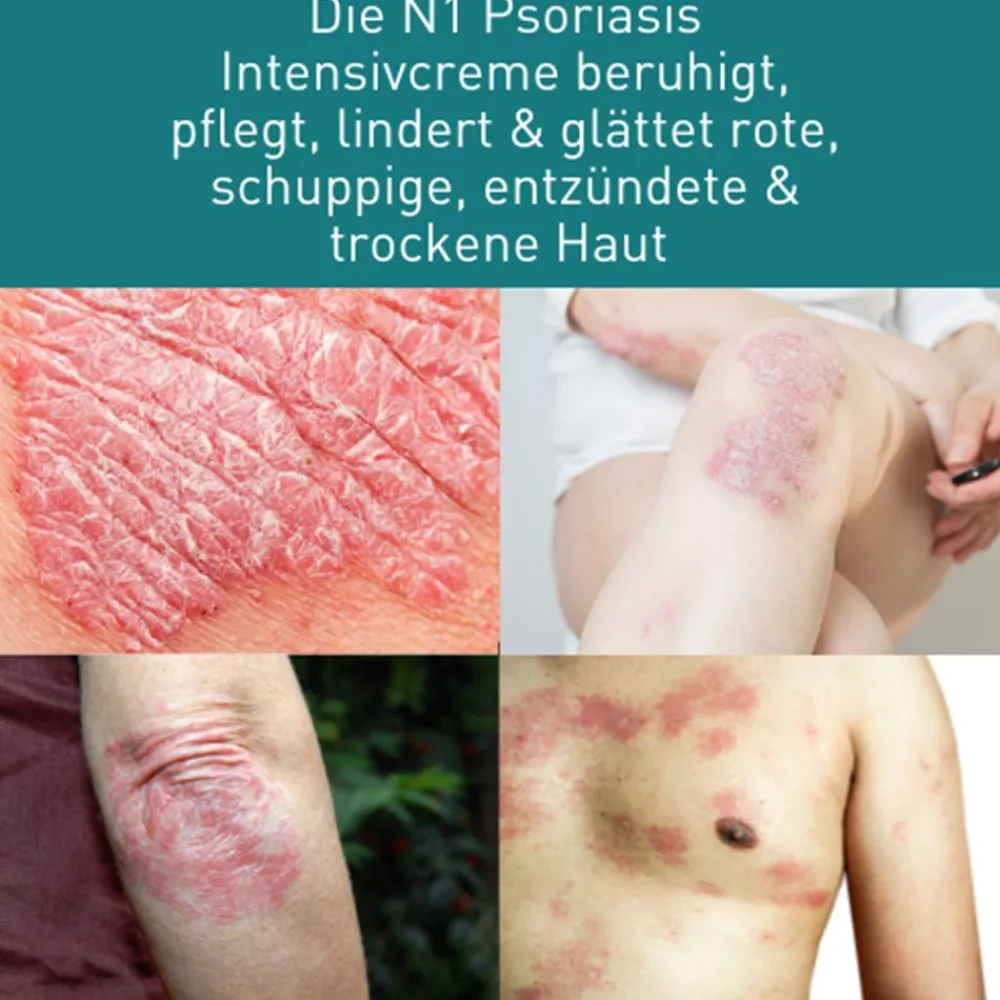 Psoriasis & Neurodermitis Intensivcreme gegen trockene, gereizte & schuppige Haut>N1 Hot