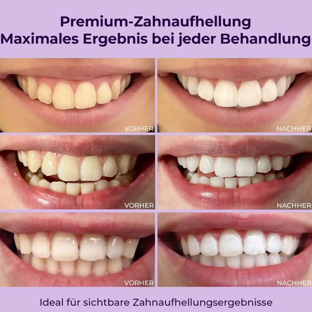 Onlysmile® All-in-One Bundle – Zahnbleaching Set, Gel, Zahnpulver & 2x Zahnpasta> Hot