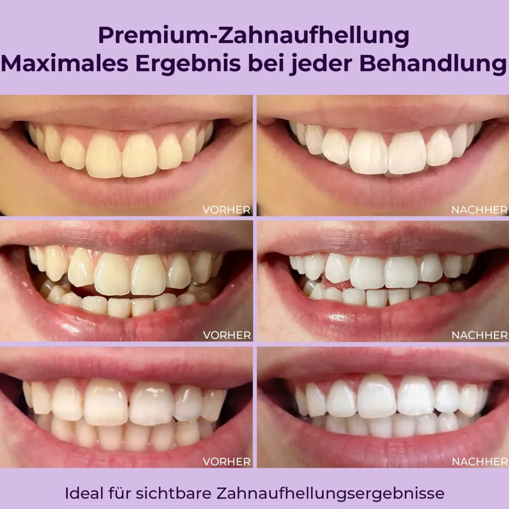 OnlySmile® Zahnaufhellung Bleaching Gel> Hot