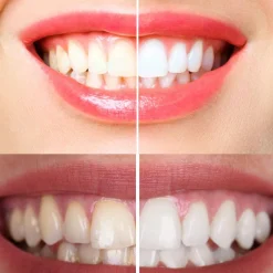 OptiSmile Aktivkohle Zahnaufhellungsstreifen - sichtbar weißere Zähne|