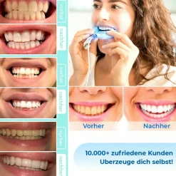 Zahnaufhellung Gel Stift für weiße Zähne|P-BEAUTY Best