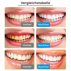 Zahnbleaching-Gel Stift für weiße Zähne><noscript><img width=