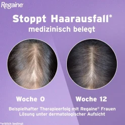 Regaine Frauen Lösung mit Minoxidil bei erblich bedingtem Haarausfall| Sale