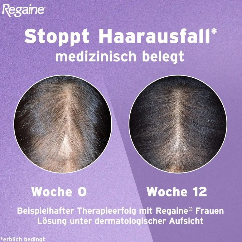 Regaine Frauen Lösung mit Minoxidil bei erblich bedingtem Haarausfall| Sale