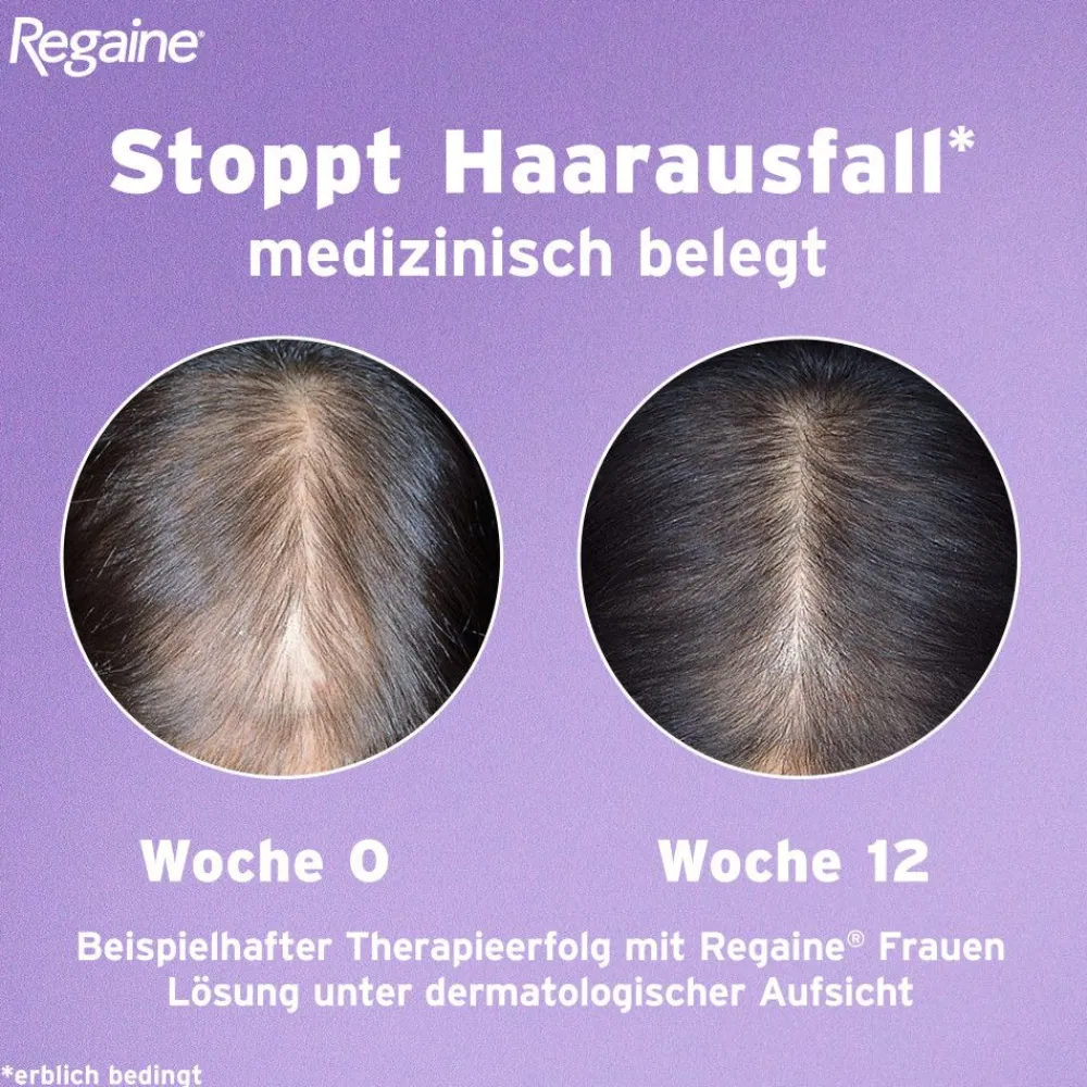 Frauen Schaum mit Minoxidil bei erblich bedingtem Haarausfall - Jetzt 20% mit dem Code 20 sparen*|Regaine Clearance