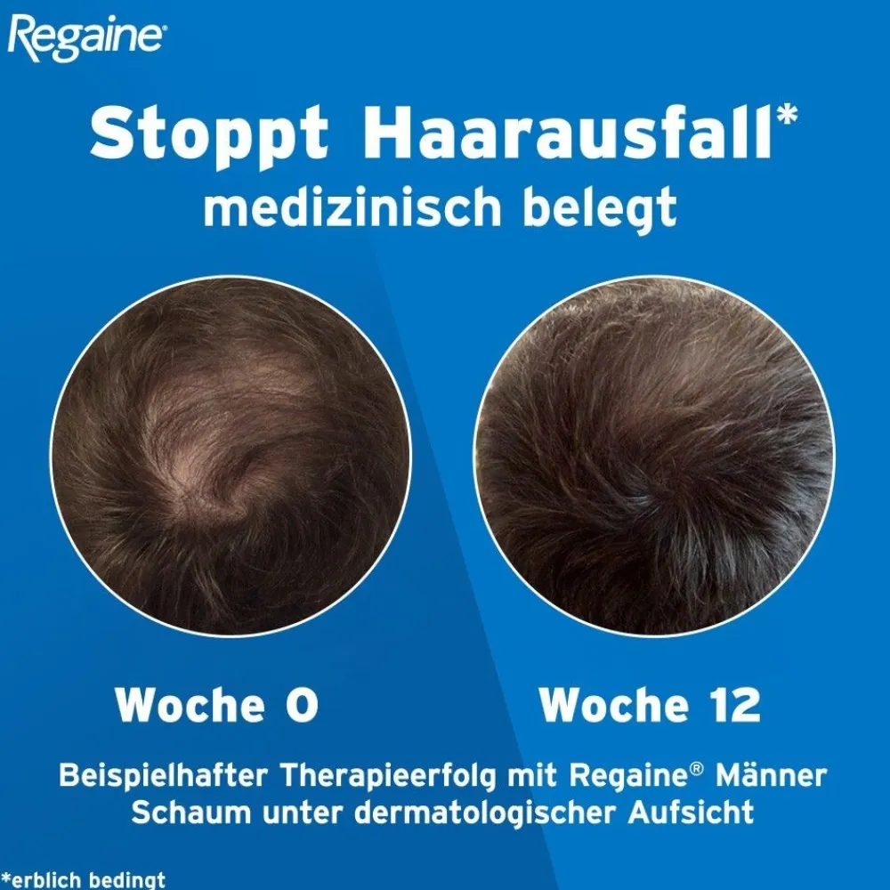 Regaine Männer Lösung mit Minoxidil bei erblich bedingtem Haarausfall> Sale