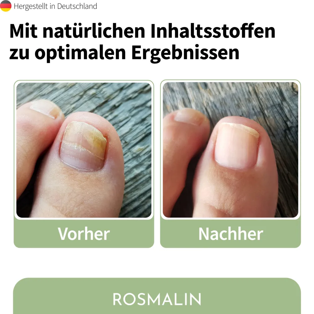 Rosmalin® Nail Care Pen - Nagelpilz Pflege>