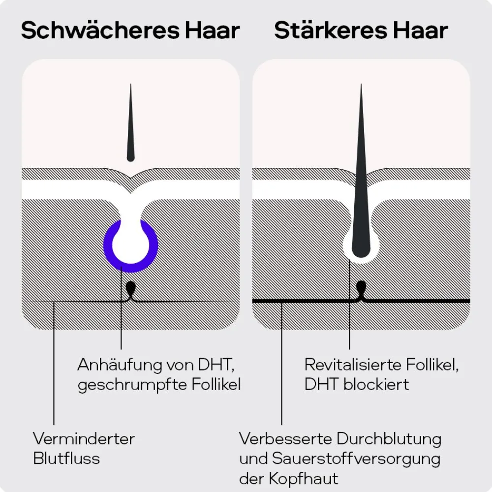 SONS Minoxidil 50mg/ml Lösung & Derma Roller für Männer bei erblich bedingtem Haarausfall> Online