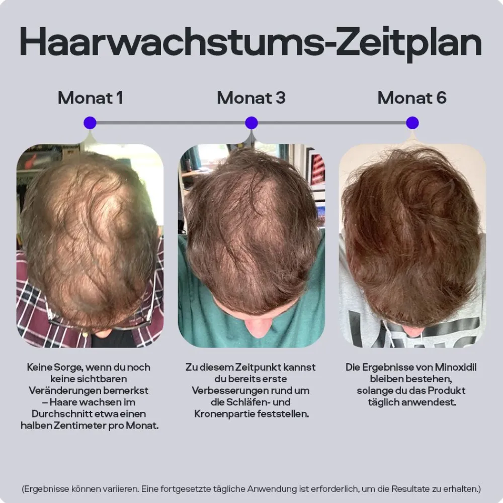 SONS Minoxidil 50mg/ml Lösung & Derma Roller für Männer bei erblich bedingtem Haarausfall> Online