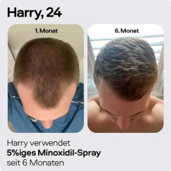 SONS Minoxidil 50mg/ml Lösung für Männer bei erblich bedingtem Haarausfall, Pumpspender,  3 Monate| Best